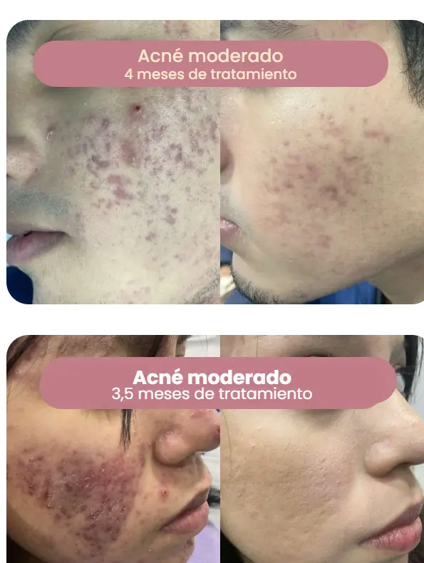 Casos de acné moderado — evolución del tratamiento