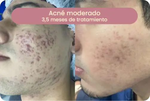 Caso de acné moderado — 1 mes de tratamiento