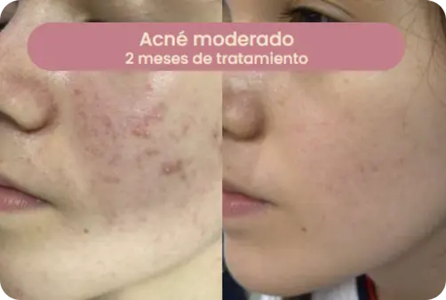 Caso de acné moderado — 2 meses de tratamiento
